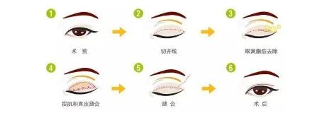祛除腫眼泡不止是抽脂而已,還有這些解決方法