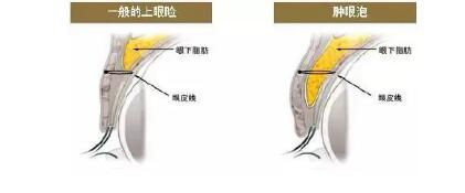祛除腫眼泡不止是抽脂而已,還有這些解決方法